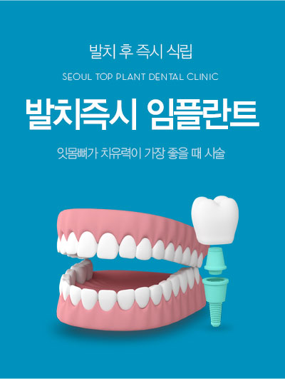 ��ġ��� ���ö�Ʈ